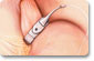 Lap Band Surgery Lap Band Surgery
