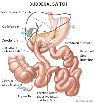 Duodenal Switch Diagram